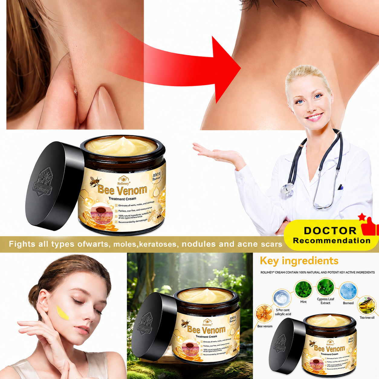 ✅✅Rolimey® Bee Venom Skin Treatment Cream - (Helping with acne, rosacea, psoriasis, age spots, eczema, and reducing the appearance of stretch marks)
