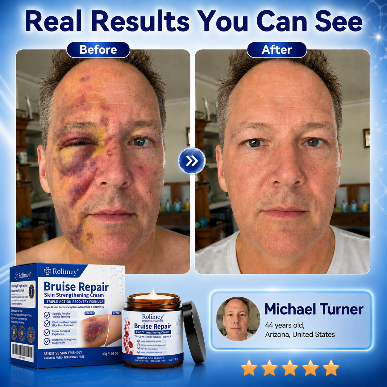 💦💦Over 100,000 units sold👨‍⚕️ - Rolimey® cream to repair bruises and strengthen the skin.