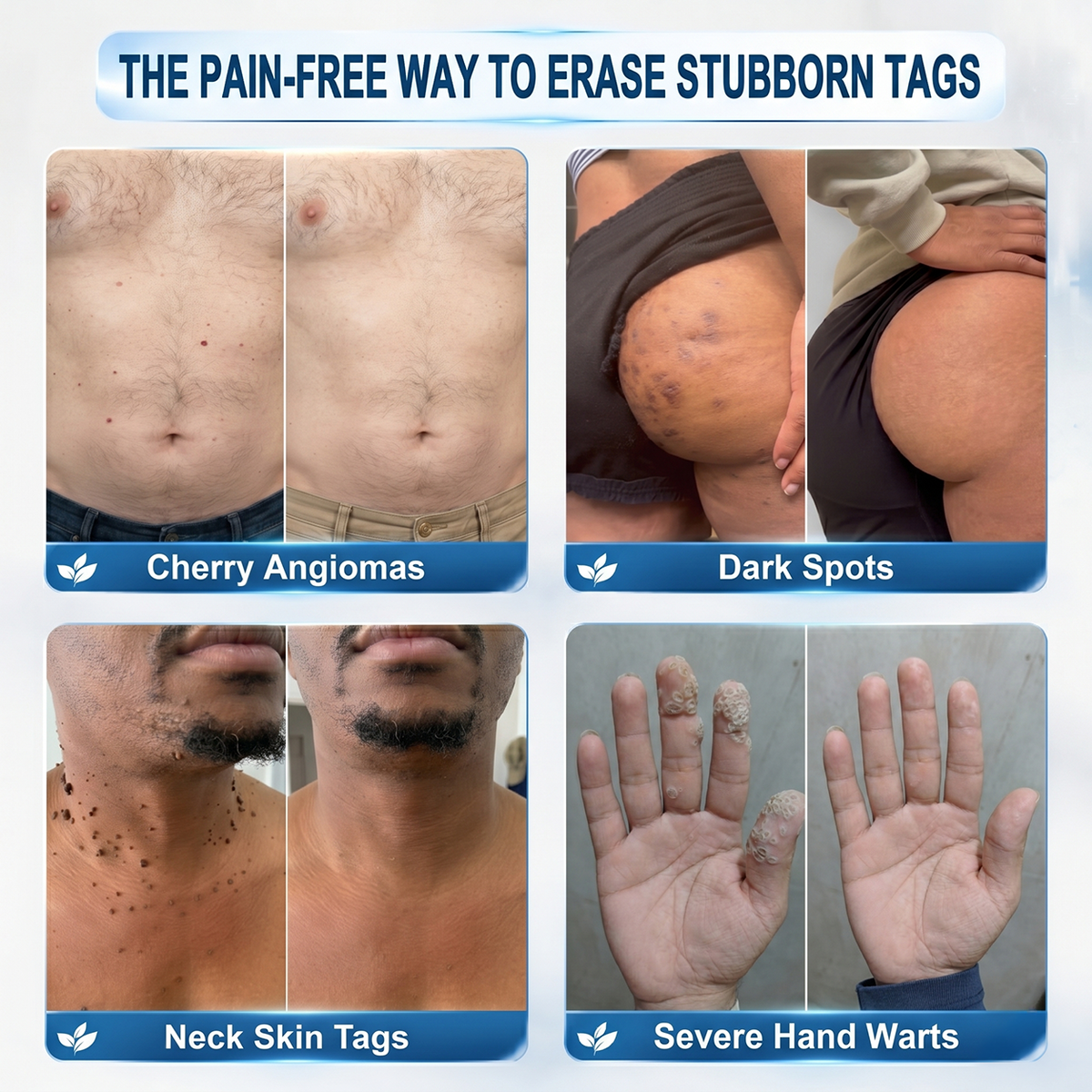 👩‍⚕️🏆 𝐎𝐟𝐟𝐢𝐜𝐢𝐚𝐥 𝐒𝐭𝐨𝐫𝐞 | GFOUK® 🌿 Botanical Microneedle Hydrocolloid Patch (For Skin Tags, Small Skin Growths, Warts, Moles, Age Spots & Pigmentation Concerns)