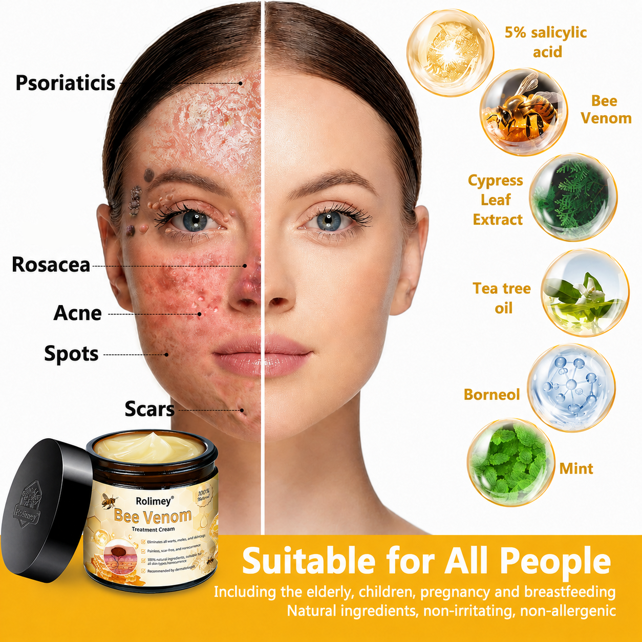 ✅✅Rolimey® Bee Venom Skin Treatment Cream - (Helping with acne, rosacea, psoriasis, age spots, eczema, and reducing the appearance of stretch marks)
