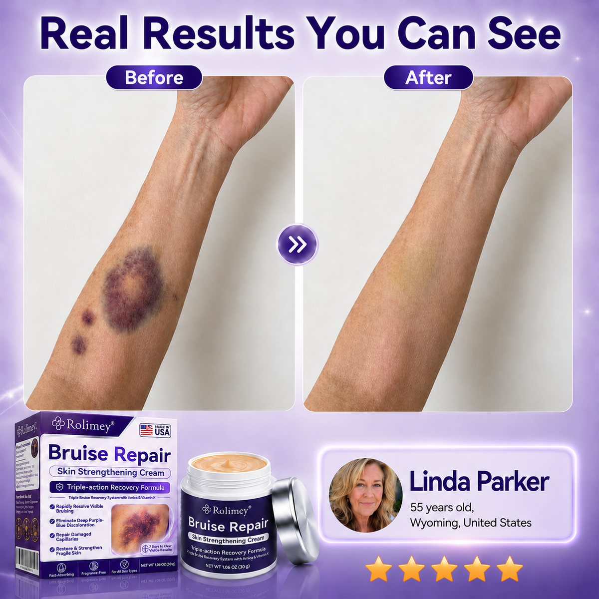👨‍⚕️Over 100,000 units sold💕 - Rolimey® cream to repair bruises and strengthen the skin