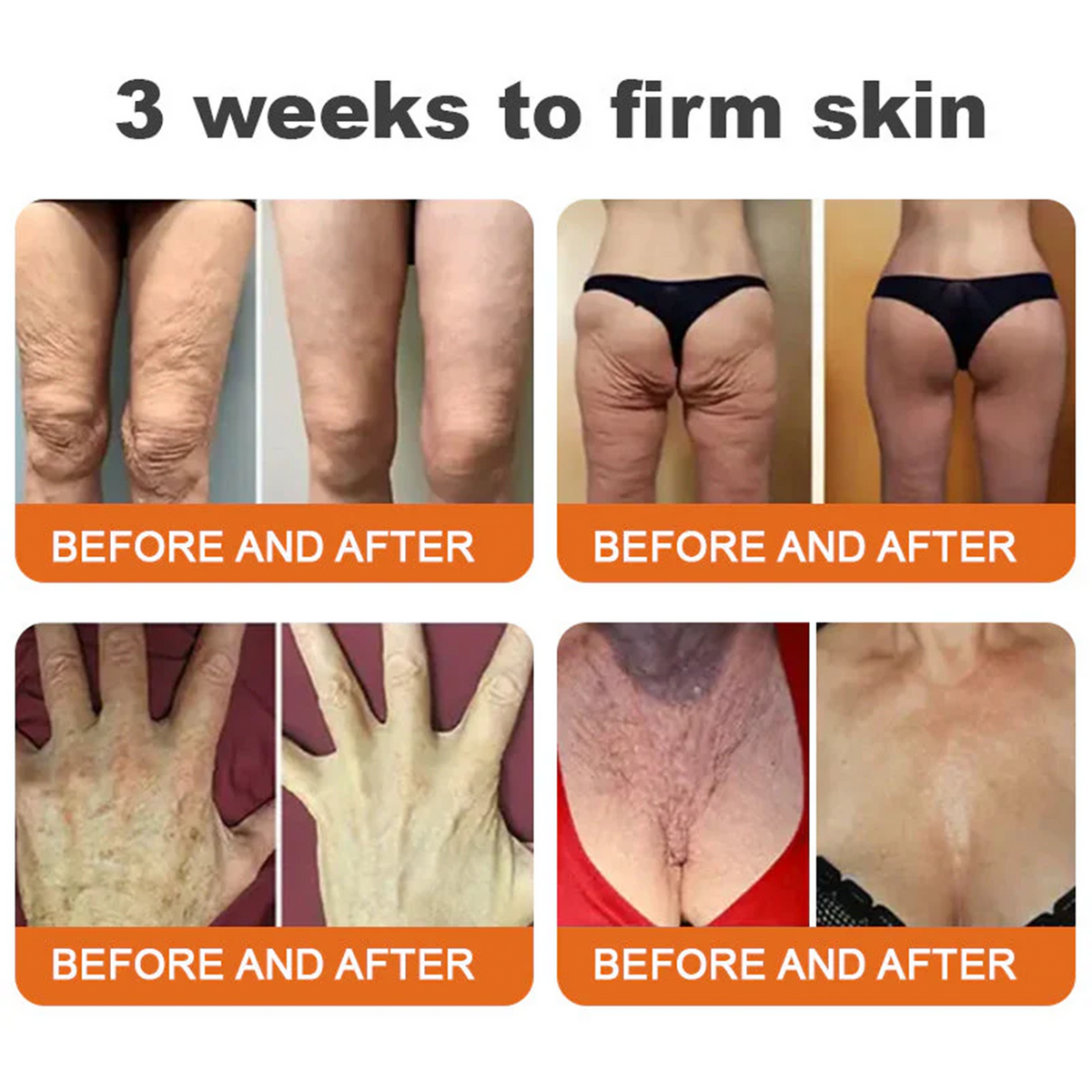 ✅✅Rolimey® Bee Venom Skin Treatment Cream - (Helping with acne, rosacea, psoriasis, age spots, eczema, and reducing the appearance of stretch marks)