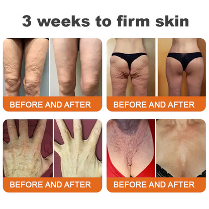 ✅✅Rolimey® Bee Venom Skin Treatment Cream - (Helping with acne, rosacea, psoriasis, age spots, eczema, and reducing the appearance of stretch marks)