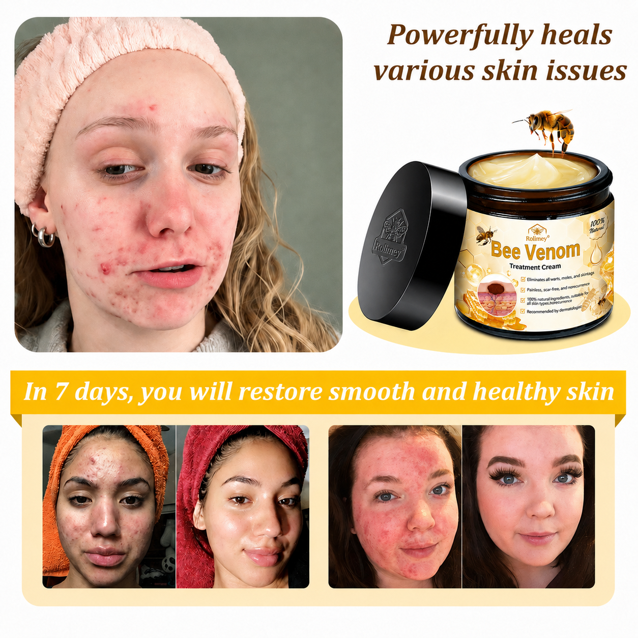 🔥Rolimey® Bee Venom Skin Treatment Cream - (Helping with acne, wart, rosacea, psoriasis, age spots, eczema, and reducing the appearance of stretch marks)
