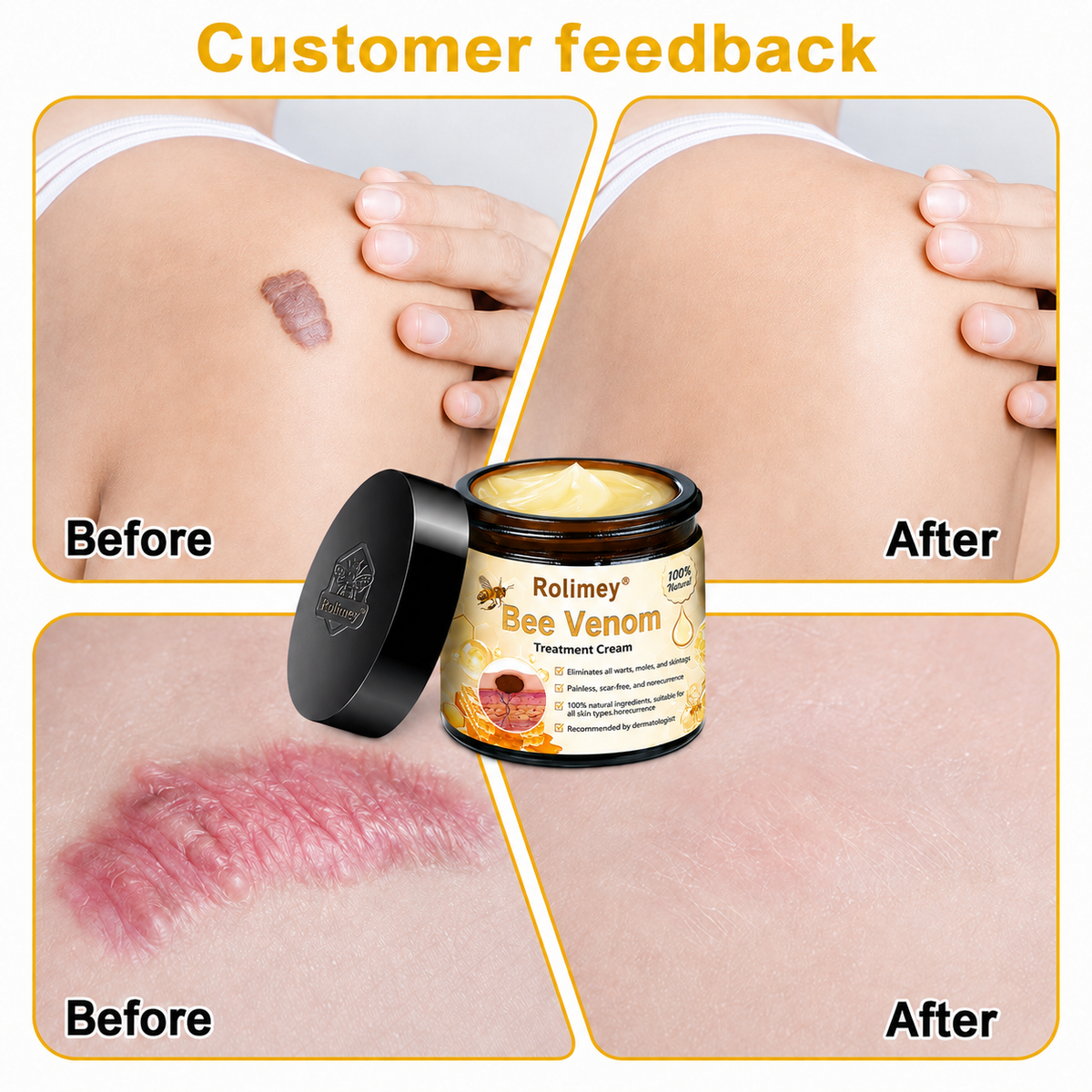 Rolimey® Bee Venom Skin Treatment Cream🔥🔥